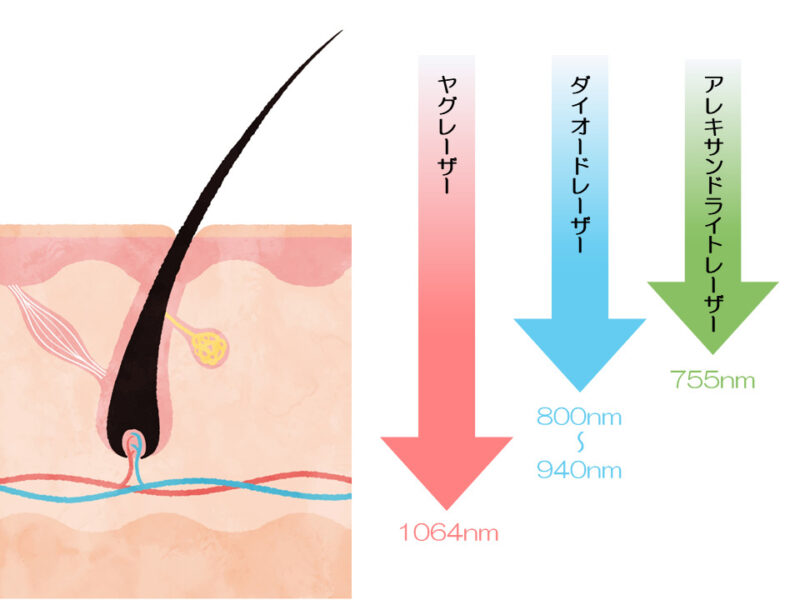 レーザー種類