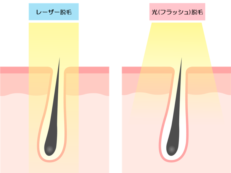 レーザー脱毛と光(フラッシュ)脱毛比較